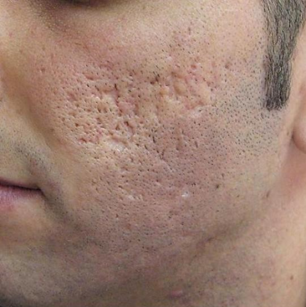 Cicatrices de acne