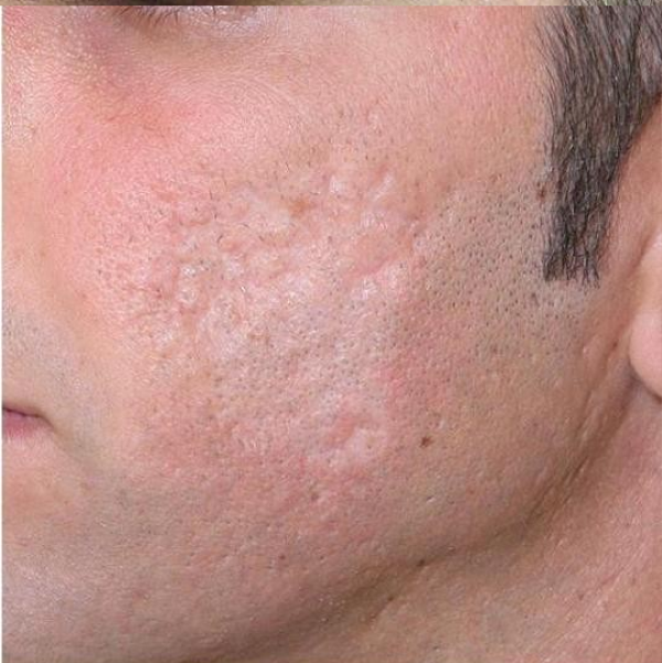 Cicatrices de acne
