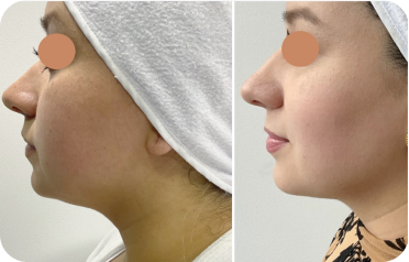 antes y despues de endolifting facial