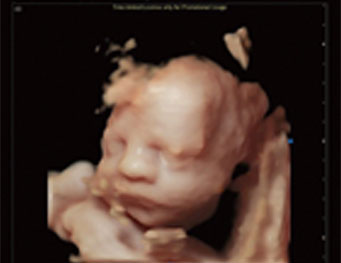 Cara fetal Virtual HD