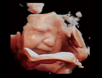 CBit 10: Cara fetal Virtual HD