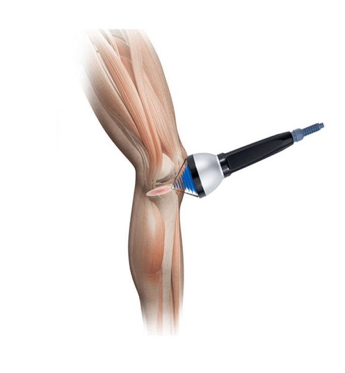 Tratamiento de la tendinitis