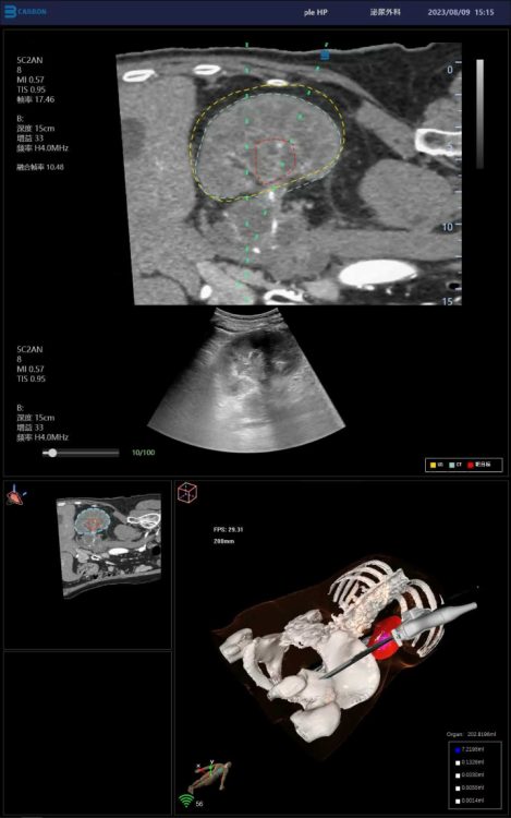 Biopsia renal guiada por fusión magnética