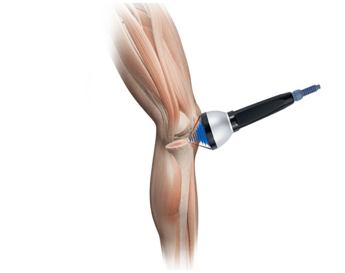 Tratamiento de la tendinitis