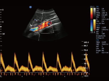 Arteria Aorta, Modo PW