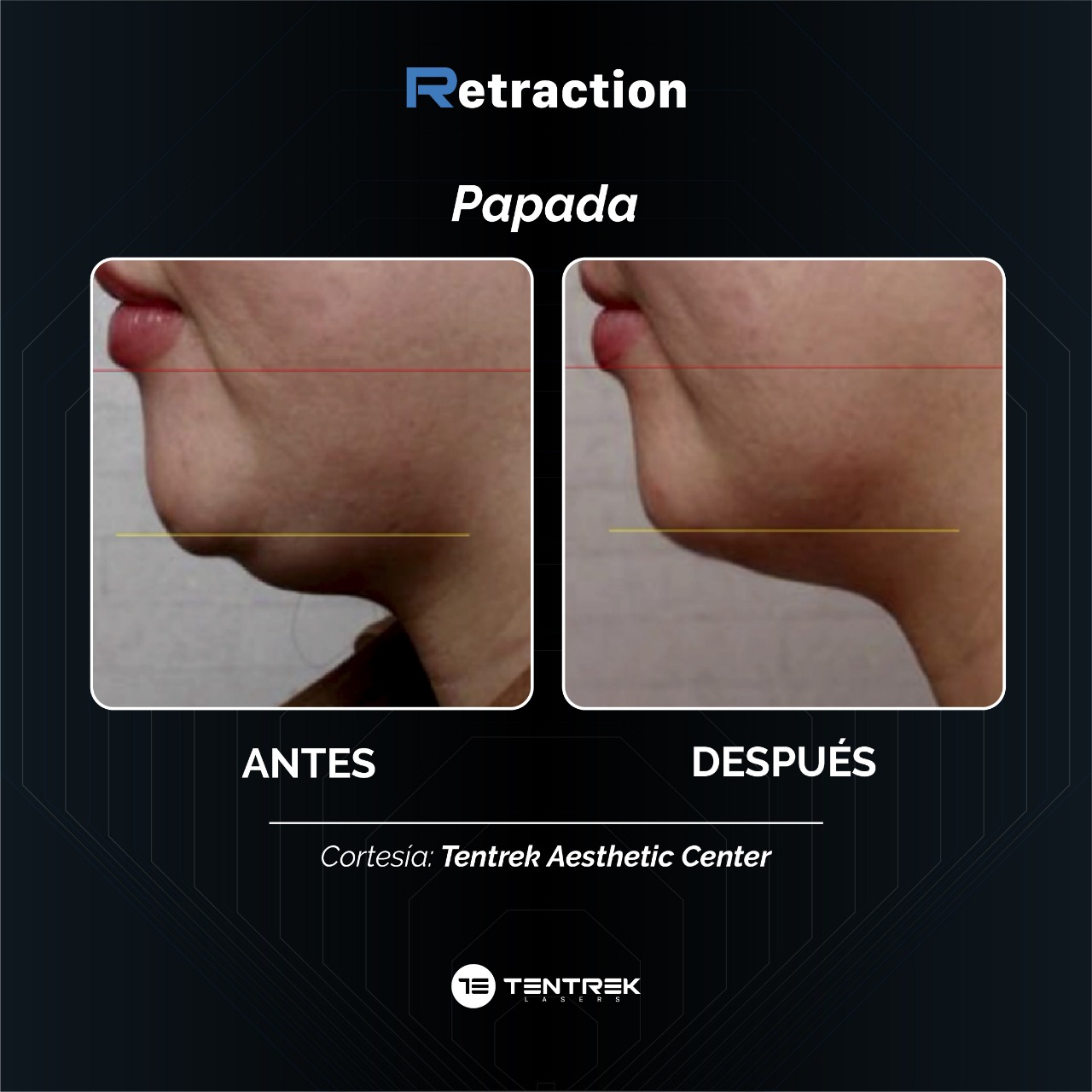 Retraction - LiftTraction en Papada