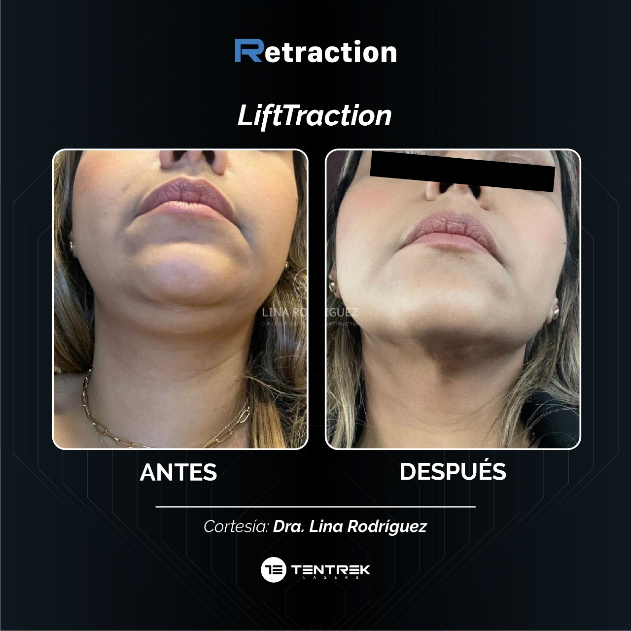 Retraction - LiftTraction en Papada