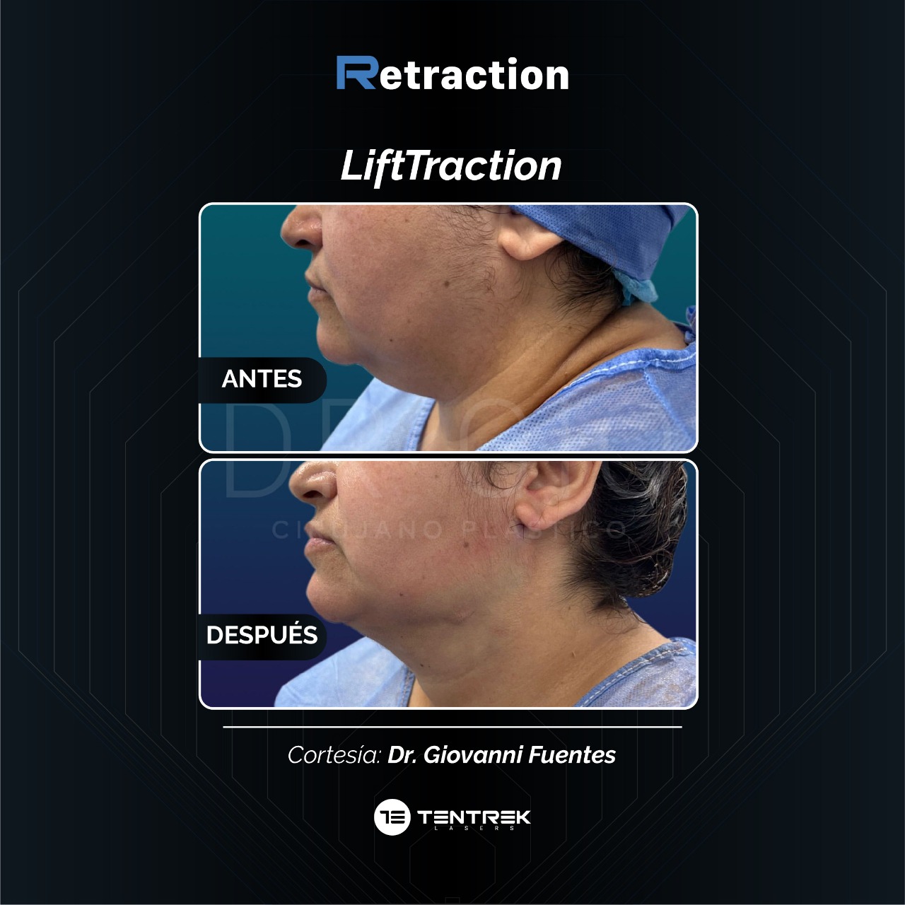 Retraction - LiftTraction en Papada