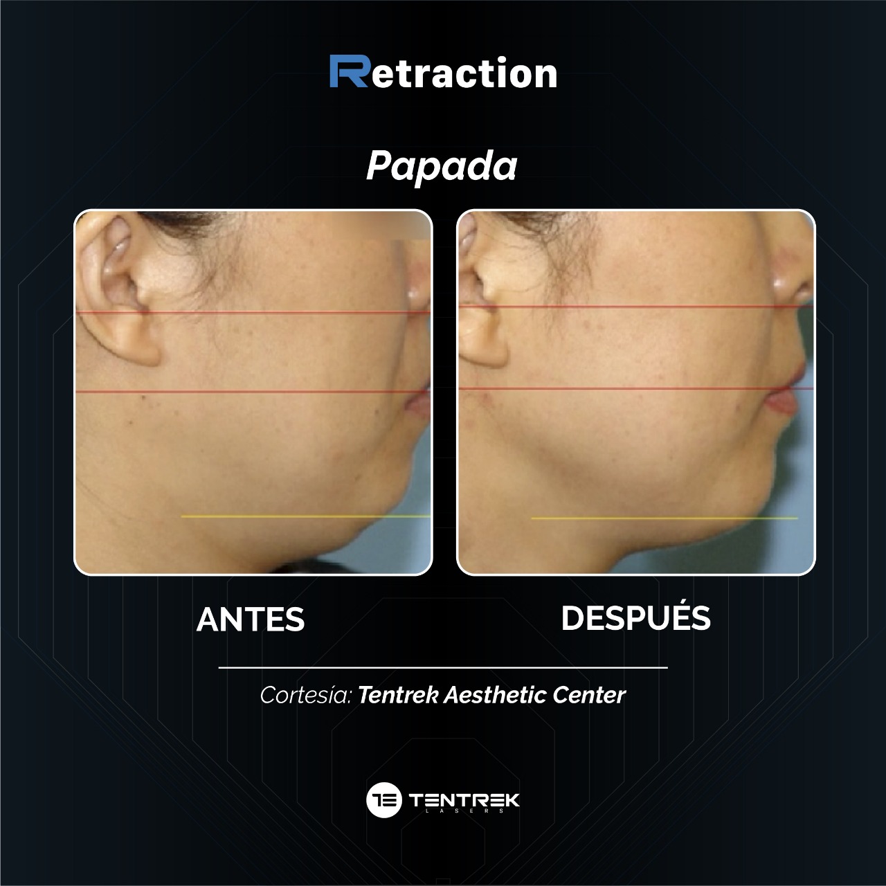 Retraction - LiftTraction en Papada