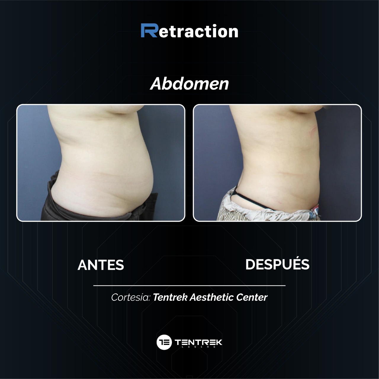 Retraction - LipoTraction