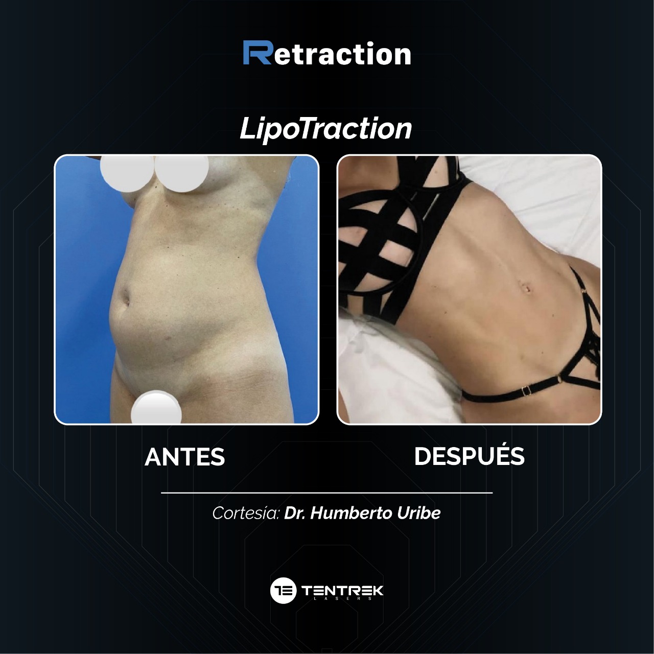 Retraction - LipoTraction