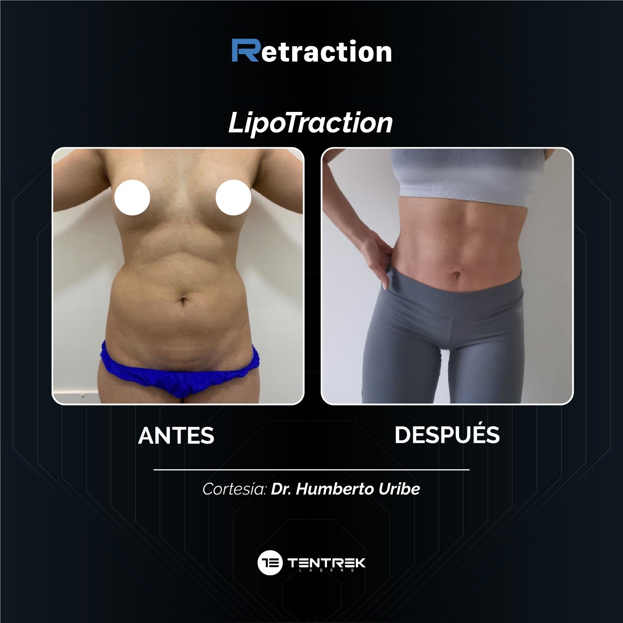 Retraction - LipoTraction