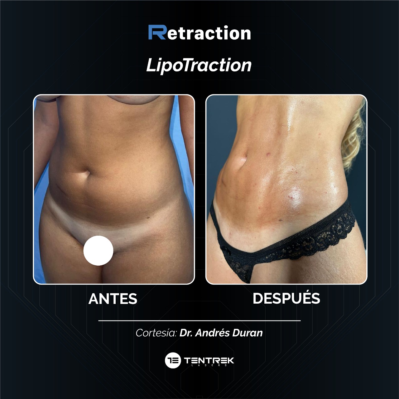 Retraction - LipoTraction