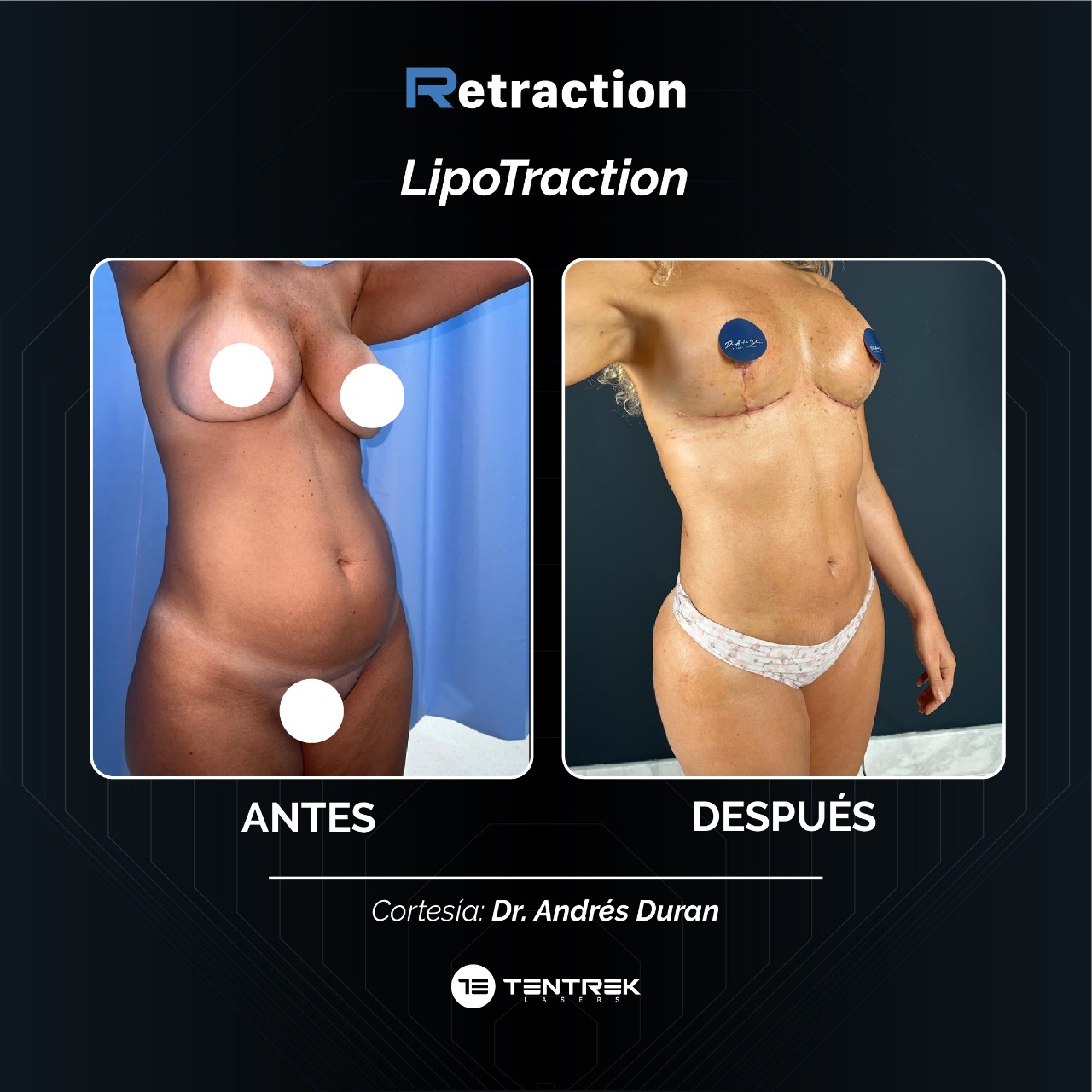 Retraction - LipoTraction