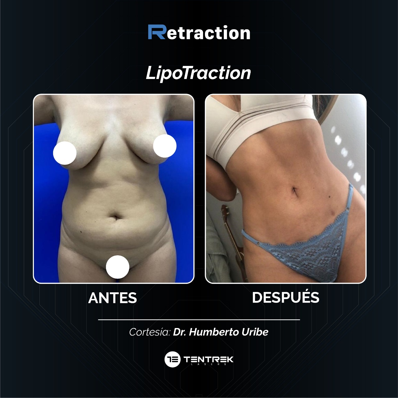 Retraction - LipoTraction