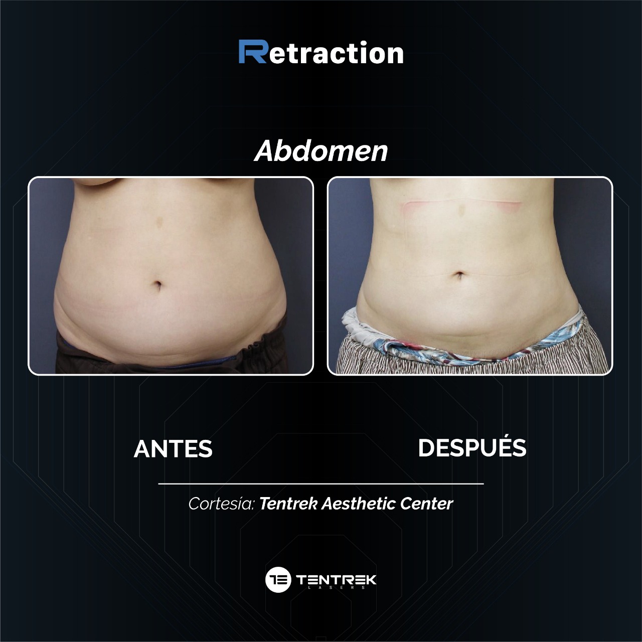 Retraction - LipoTraction