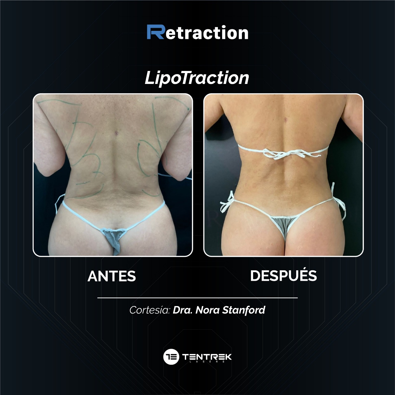 Retraction - LipoTraction en Contorno