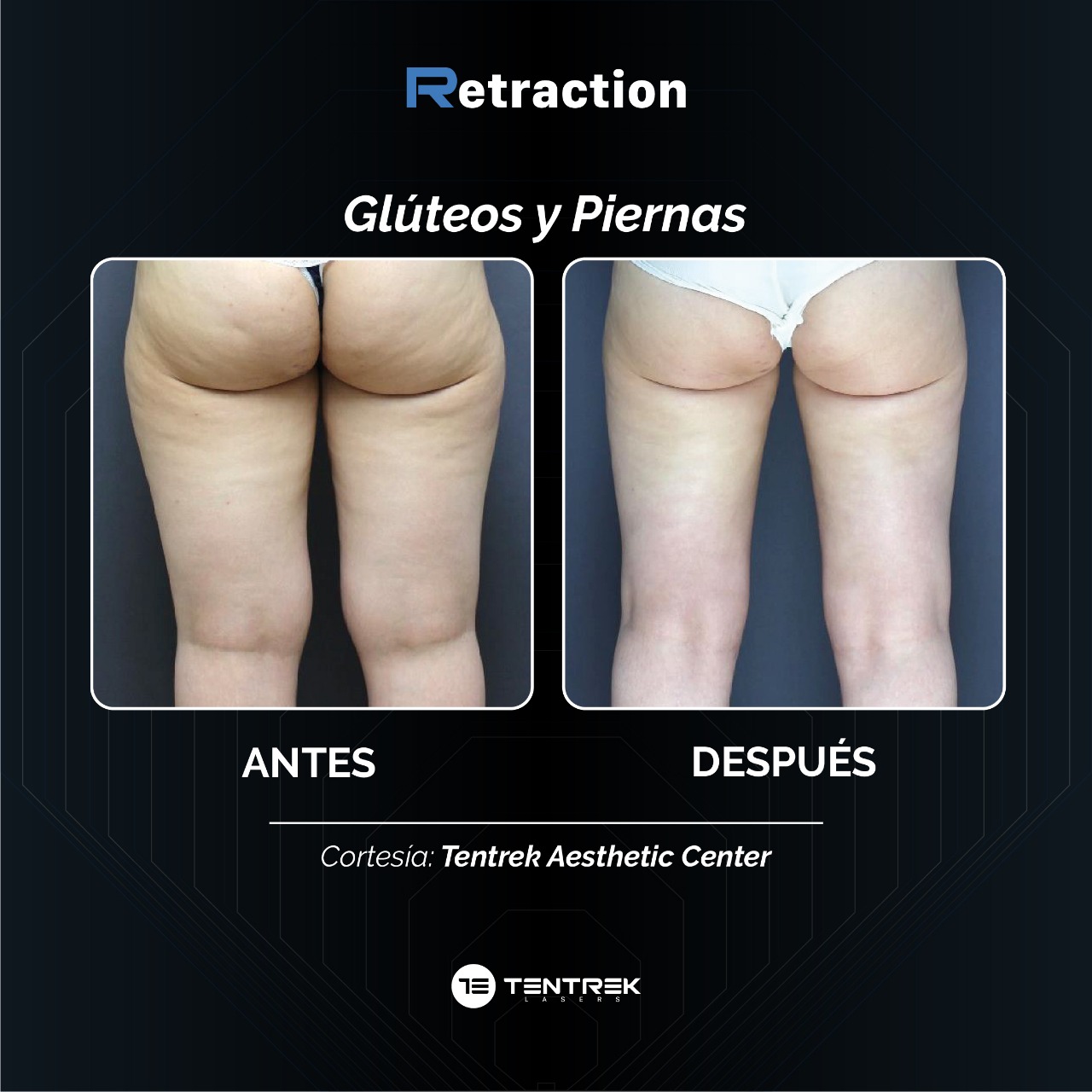 Retraction - LipoTraction en Muslos y Gluteos