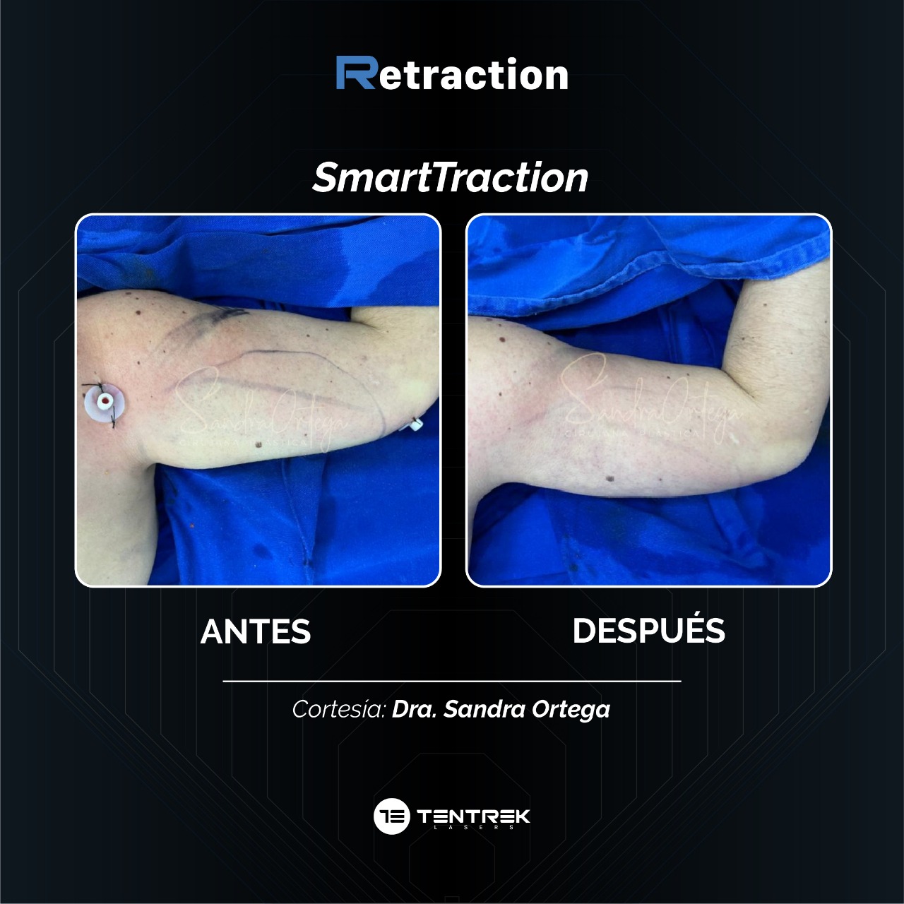 Retraction - SmartTraction en Brazos