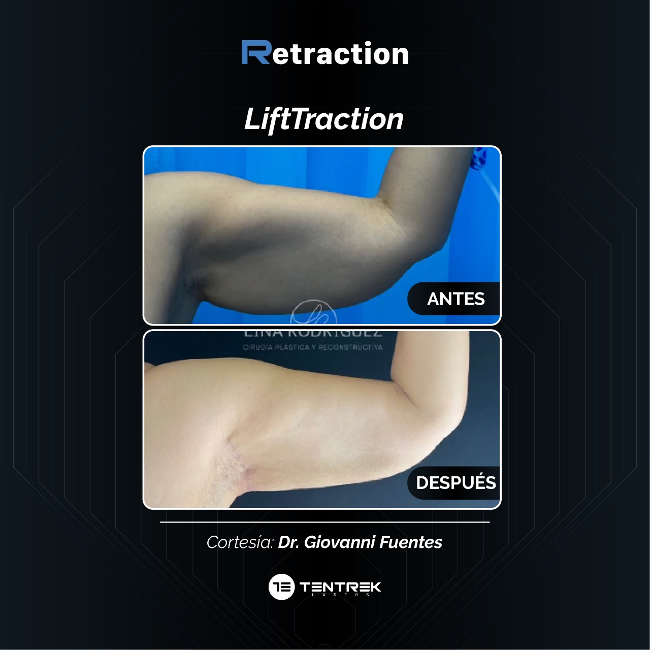 Retraction - SmartTraction en Brazos