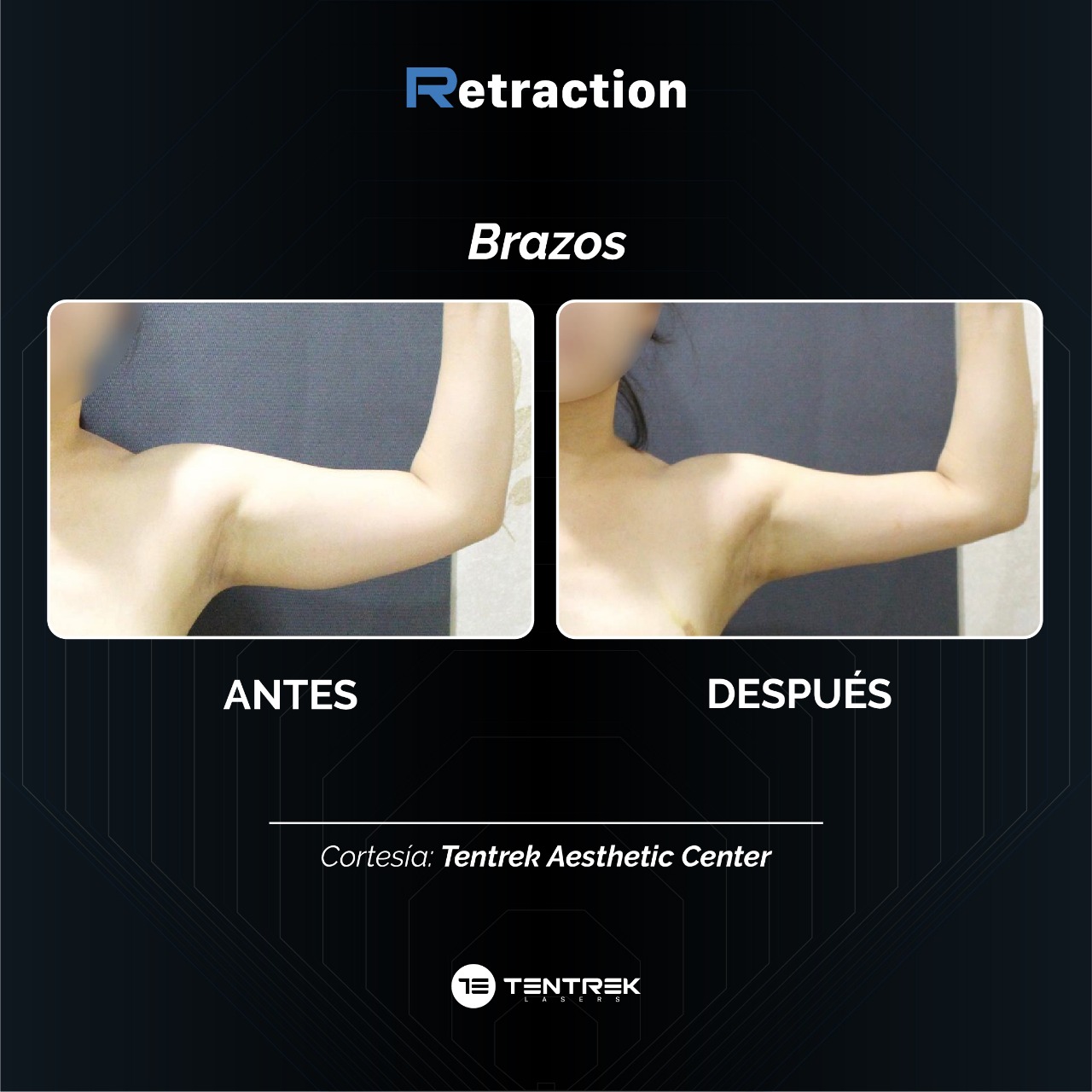 Retraction - SmartTraction en Brazos