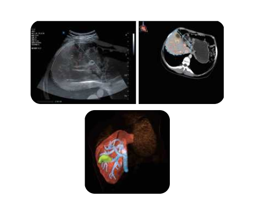 Venus hepatologia