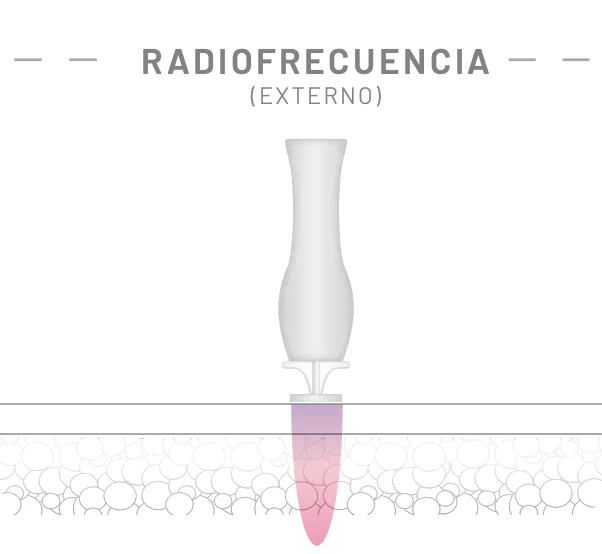 radiofrecuencia